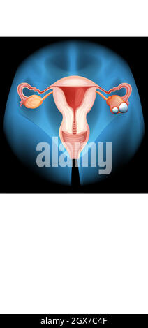 Cancro ovarico in donna Illustrazione Vettoriale