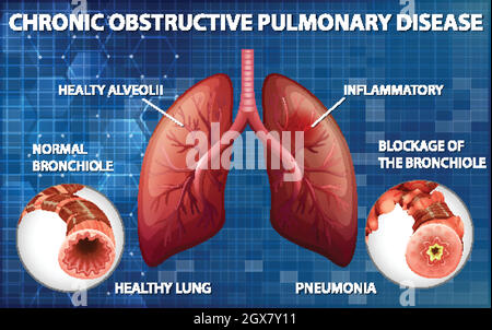 Polmone con malattia polmonare ostruttiva cronica Illustrazione Vettoriale