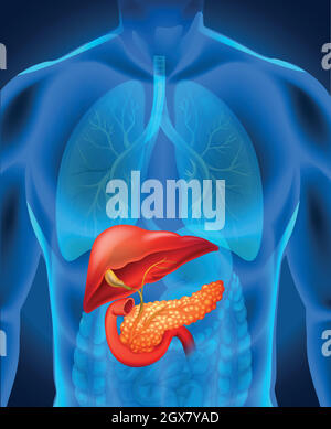 Cancro del pancreas nel corpo umano Illustrazione Vettoriale