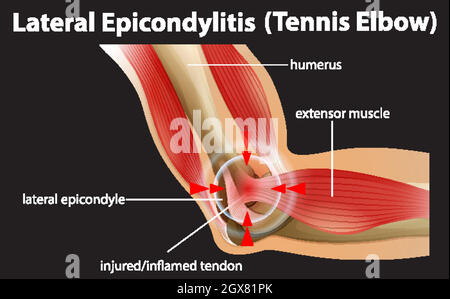 Epicondilite laterale o gomito da tennis Illustrazione Vettoriale