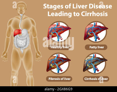 Stadi di malattia epatica che portano alla cirrosi Illustrazione Vettoriale