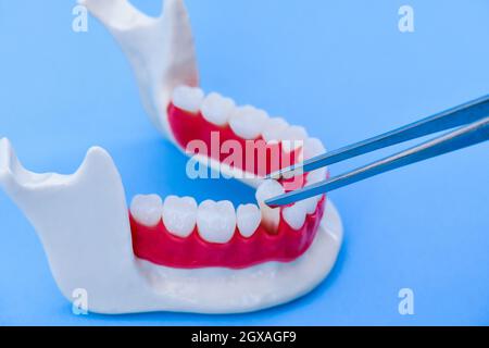 Pinzette tirando il dente dalla mascella inferiore modello anatomico Illustrazione medica isolato su sfondo blu. Denti sani, cura dentale ortodontico e c Foto Stock