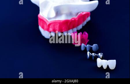 Impianto di denti della corona e del processo di installazione isolata su uno sfondo blu. Accurata dal punto di vista medico 3D illustrazione Foto Stock