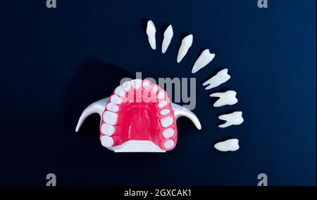 Impianto di denti della corona e del processo di installazione isolata su uno sfondo blu. Accurata dal punto di vista medico 3D illustrazione Foto Stock