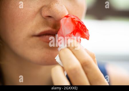 Donna cerca di fermare il sangue che fuoriesce dal naso Foto Stock