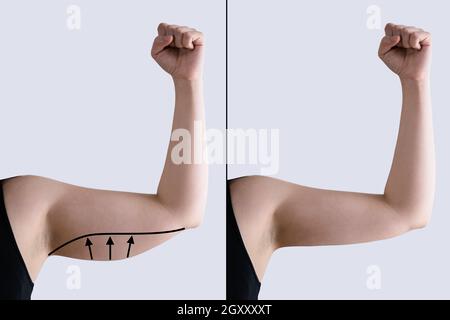 Prima e dopo chirurgia della cellulite del braccio e Liposuzione. Visualizzazione dei risultati Foto Stock
