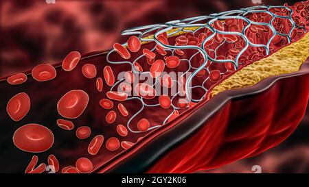 Illustrazione del rendering 3D dell'angioplastica. Stent dispiegato all'interno di un'arteria malata o vaso sanguigno ostruito da colesterolo o placca di ateroma con sangue fl Foto Stock