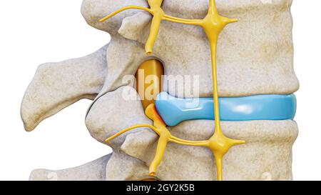 Disco erniato con compressione del nervo spinale rappresentazione 3D vista laterale isolata su sfondo bianco. Lesione della colonna vertebrale o della colonna vertebrale, AN Foto Stock