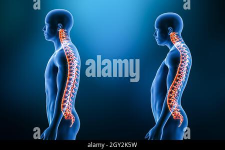 Confronto tra il backbone normale e la curvatura della lordosi della colonna vertebrale con il modello uomo dalla vista laterale illustrazione di rendering 3D. Anatomia umana, spin Foto Stock