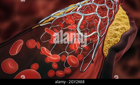 Illustrazione del rendering 3D dell'angioplastica. Stent dispiegato all'interno di un'arteria malata o vaso sanguigno ostruito da colesterolo o placca di ateroma con sangue fl Foto Stock
