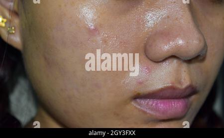 Acne , macchie nere e cicatrici sulla faccia oleosa della giovane donna asiatica. Primo piano. Foto Stock