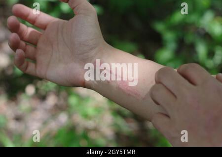 Un primo piano di una donna che gratta la sua avvelenata edera mentre si trova su un sentiero escursionistico Foto Stock