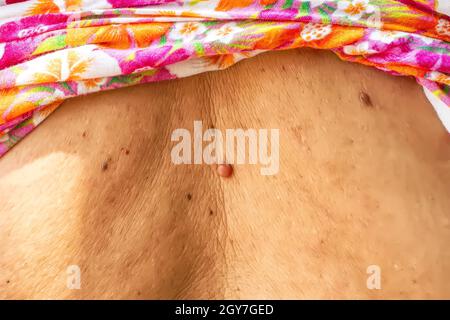 Tag di pelle o acrochondon o soft fibroma è una cassetta di sicurezza. Essa non hanno effetto sul corpo. Di solito avviene presso il collo, il viso, le ascelle e il corpo. Foto Stock