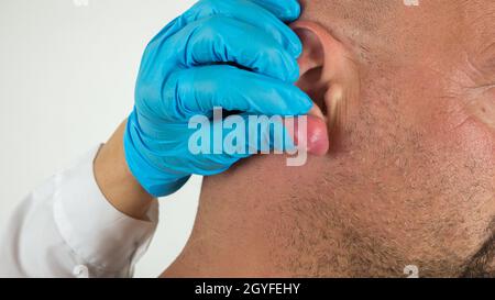 medico con guanti blu che esamina un ascesso con pus su un orecchio gonfio e infiammato, di un uomo caucasico. Foto Stock