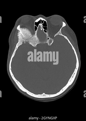 Meningioma intraosseo, scansione TC Foto Stock