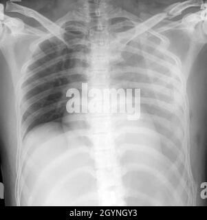 Emotorace e fratture multiple, raggi X. Foto Stock