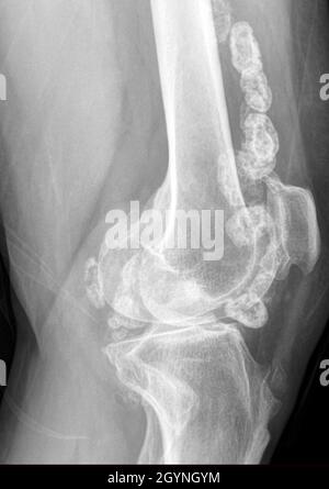 Condromatosi sinoviale, raggi X. Foto Stock