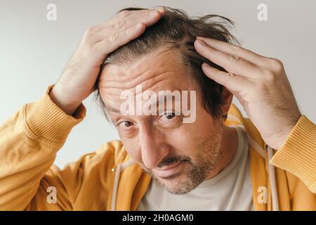 Perdita dei capelli, uomo che guarda lo specchio preoccupato di perdere i capelli alla fronte, fuoco selettivo Foto Stock