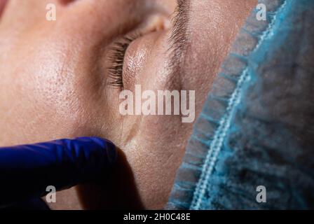 Una cicatrice profonda sul viso della ragazza vicino all'occhio. Concetto per rimuovere le cicatrici in cosmetologia utilizzando il ripurfacing laser Foto Stock