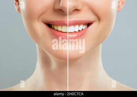 Donna denti prima e dopo sbiancamento. Su sfondo bianco. Clinica dentale del paziente. Immagine simboleggia la cura orale odontoiatria, stomatologia Foto Stock