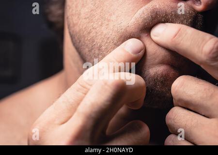 Un uomo preme un pimple sul viso - un ascesso infiammato sulla pelle del viso Foto Stock