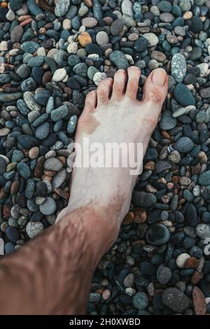 Il problema della radiazione solare sulla pelle sotto forma di macchie - una violazione della pigmentazione - una gamba uomo con macchie bianche Foto Stock