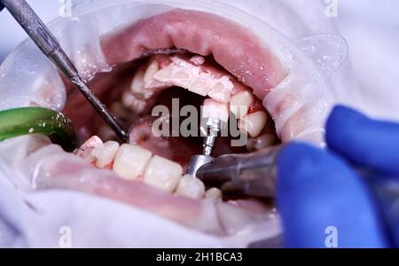 Fotografia macro. Vista dall'alto del processo di pulizia nella bocca del paziente con l'ausilio di spazzola dentata, spazzola meccanica, specchio ed espulsore della saliva. Concetto di procedure dentarie Foto Stock