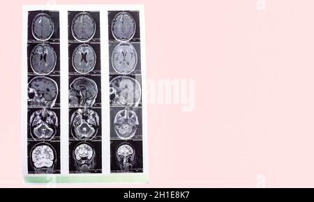 L'immagine di risonanza magnetica o MRI del cervello maschile Foto Stock