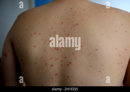 salvador, bahia / brasile - 11 aprile 2019: L'uomo mostra parti del corpo infettate con sintomi di sindrome di mano e piede e bocca, noto come Roseola. *** Loc Foto Stock
