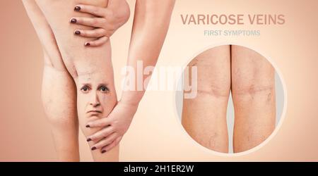 Gambe con vene varicose. Immagine ritagliata della donna che massaggiava le gambe stanche. Concetto di dolore ed emozioni umane. Vena ragno dolorosa sulle gambe femminili. Collag Foto Stock