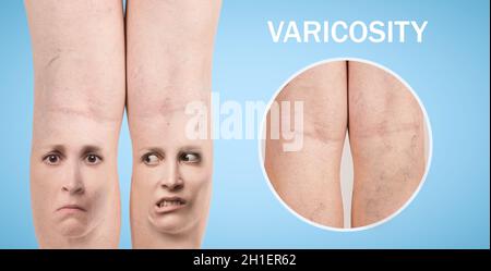 Gambe con vene varicose. Immagine ritagliata della donna che massaggiava le gambe stanche. Concetto di dolore ed emozioni umane. Vena ragno dolorosa sulle gambe femminili. Collag Foto Stock