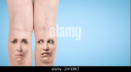 Gambe con vene varicose. Immagine ritagliata della donna che massaggiava le gambe stanche. Concetto di dolore ed emozioni umane. Vena ragno dolorosa sulle gambe femminili. Collag Foto Stock