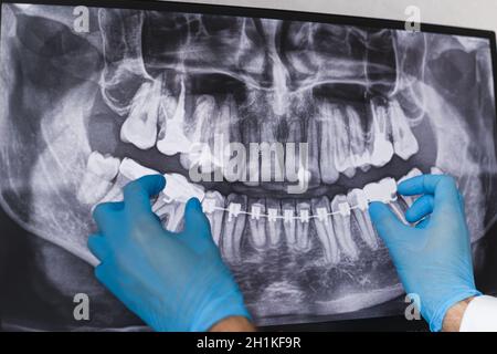 Il medico punta alle bretelle nei raggi X dentali. Foto Stock
