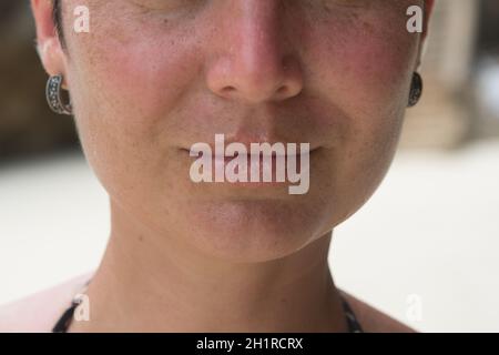 Close-up di labbri di sesso femminile affetti da herpes malattia Foto Stock