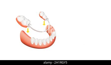 Protesi scheletrica dentale con corone in porcellana. Clasp protesica icona Illustrazione vettoriale Foto Stock