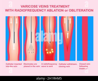 Vene varicose. Trattamento con ablazione a radiofrequenza orobliterazione delle gambe. Illustrazione del vettore icona Foto Stock