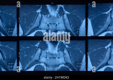 MRI sacroiliac articolazione. Studio della spondilite spondyloarthritis paziente. I risultati dello studio sui raggi x. Foto Stock