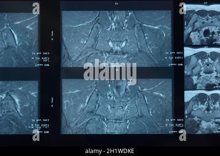 MRI sacroiliac articolazione. Studio della spondilite spondyloarthritis paziente. I risultati dello studio sui raggi x. Foto Stock