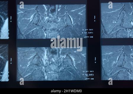 MRI sacroiliac articolazione. Studio della spondilite spondyloarthritis paziente. I risultati dello studio sui raggi x. Foto Stock