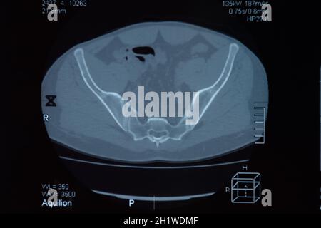 MRI sacroiliac articolazione. Studio della spondilite spondyloarthritis paziente. I risultati dello studio sui raggi x. Foto Stock