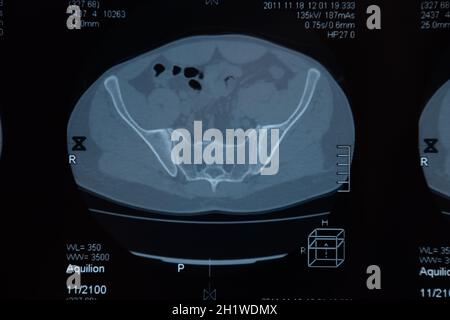 MRI sacroiliac articolazione. Studio della spondilite spondyloarthritis paziente. I risultati dello studio sui raggi x. Foto Stock