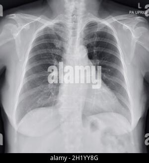 Radiografia toracica del torace o del polmone umano che mostra un polmone normale. Foto Stock