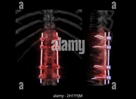 Colonna lombare AP e vista laterale per diagnosi stenosi del canale spinale e malattia degenerativa del disco che mostra l'impianto a vite pediculosa dopo la depom chirurgica Foto Stock