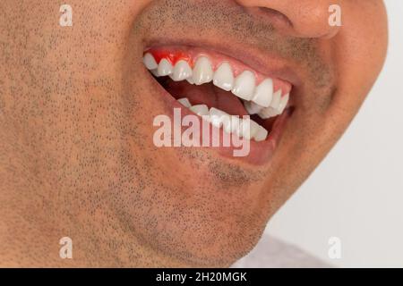 Primo piano di foto di giovane uomo adulto con pelle marrone e infiammazione delle gengive. Concetto di cura dei denti. Foto Stock