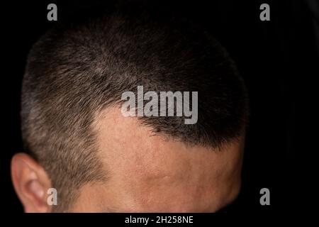 Primo piano foto di un uomo con perdita di capelli Foto Stock