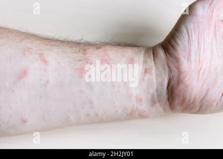 Campione di dermatite da contatto allergenica - eruzione cutanea rosa sul lato interno dell'avambraccio da vicino Foto Stock