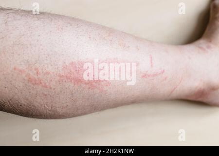 Campione di dermatite da contatto allergica - lato dello shin maschile con eruzione cutanea rossa pruriginosa Foto Stock