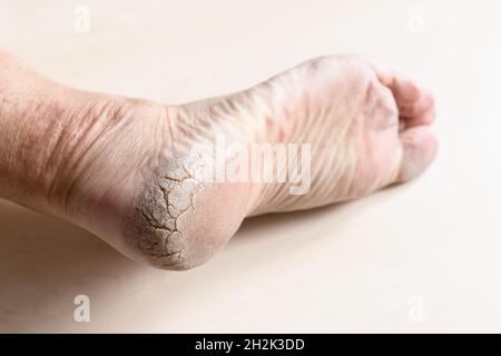 pelle secca morta spaccata sul tallone del piede maschio in primo piano Foto Stock