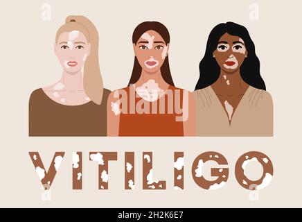 Gruppo di facce femmina con vitiligo. Poster del giorno mondiale della vitiligine. Collezione di ritratti di donne con diversi colori della pelle e acconciature. Corpo positivo Illustrazione Vettoriale