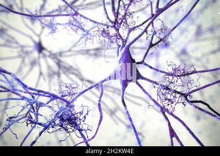 Cellule nervose colpite dal morbo di Alzheimer, illustrazione Foto Stock